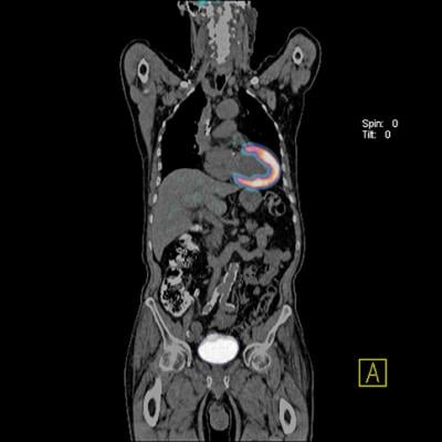 Advances in Cardiac Nuclear Imaging | DAIC